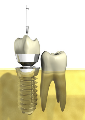 Implantatversorgung